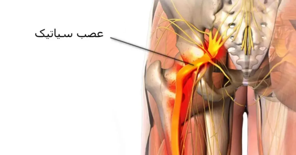45 درصد ایرانی‌ها به سیاتیک مبتلا هستند و این هشدار فلوشیپ است