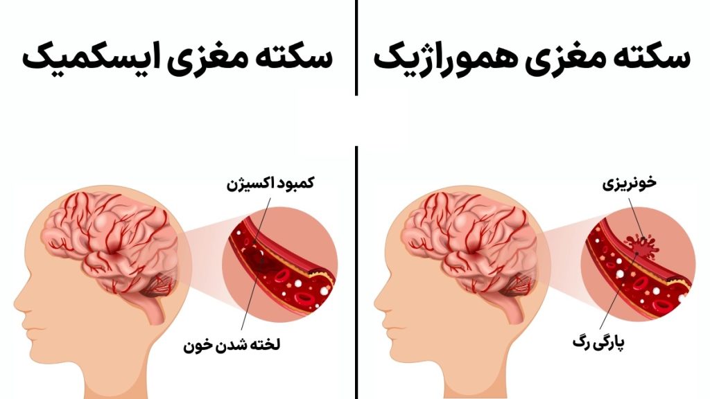 سکته مغزی در ایران دومین علت مرگ است! درمان سکته مغزی