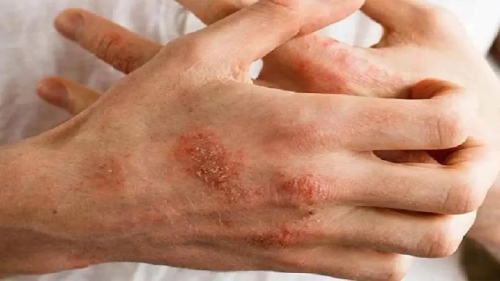 سرطان پوست و پیشگیری از آن/ هشدار برای افزایش اشعه فرابنفش