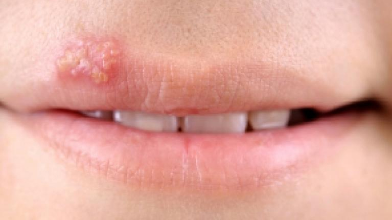 بیماری HPV ؛ واقعیت‌ها، شایعات و روش‌های اصلی انتقال بیماری