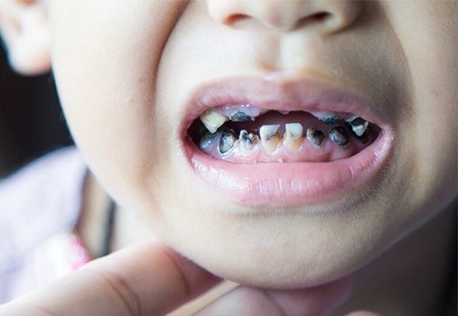 دانشآموزان دبستانی به طور میانگین ۵ دندان پوسیده دارند/اجرای پویش سلامت دهان از هفته آینده 1 children tooth decay 01