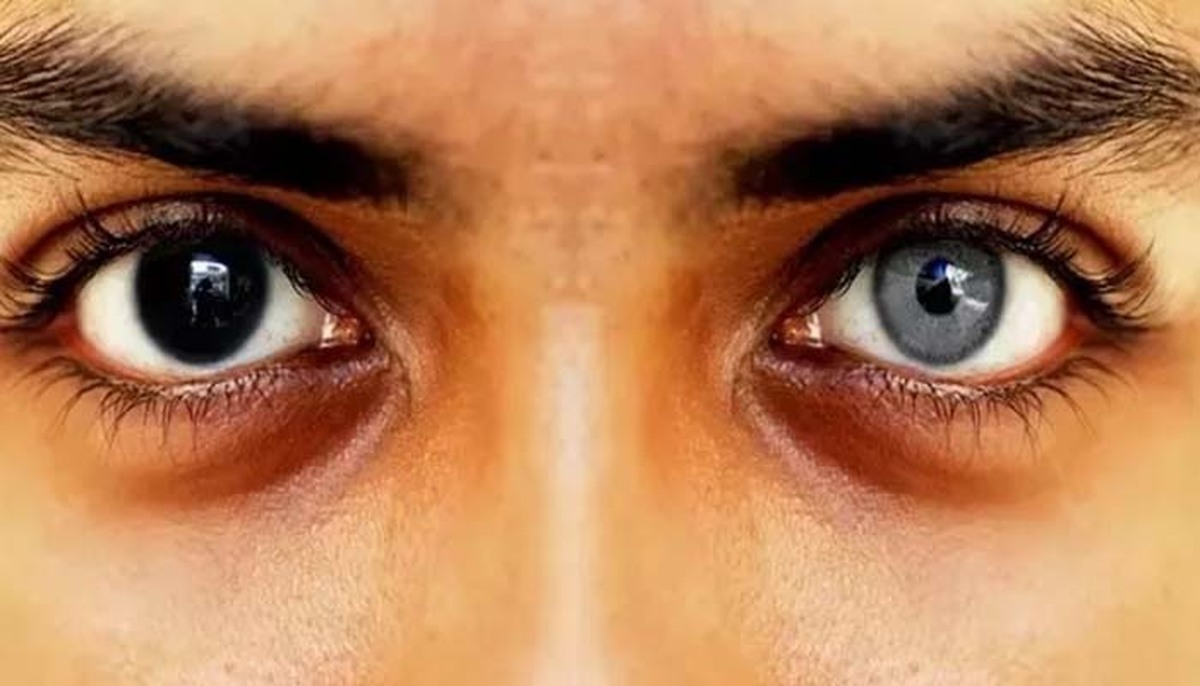 تغییر رنگ چشم در افشای جراحی ممنوعه پزشک مطرح ایرانی