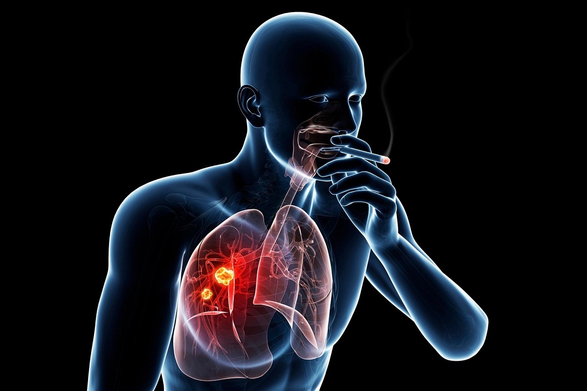 فناوری هسته‌ای؛ سلاح نوین در تشخیص سریع سرطان کشنده