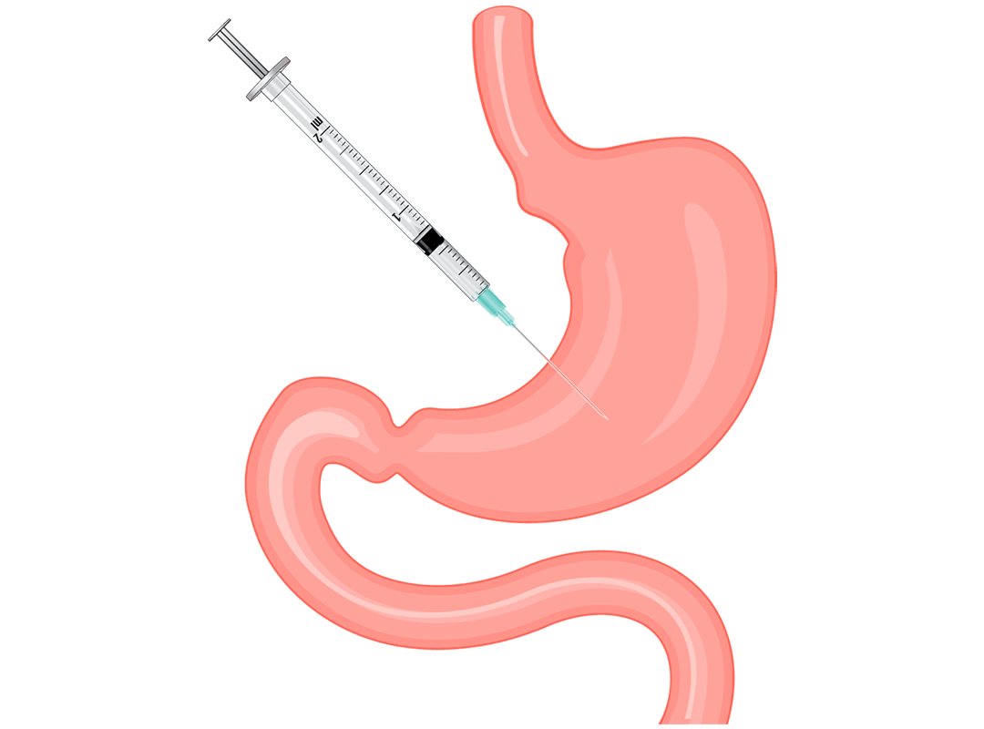 بوتاکس معده در برابر جراحی اسلیو؛ هشدار متخصصان