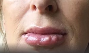 محلول‌های تزریقی زیبایی؛ هشدار جدی درباره عوارض آن‌ها